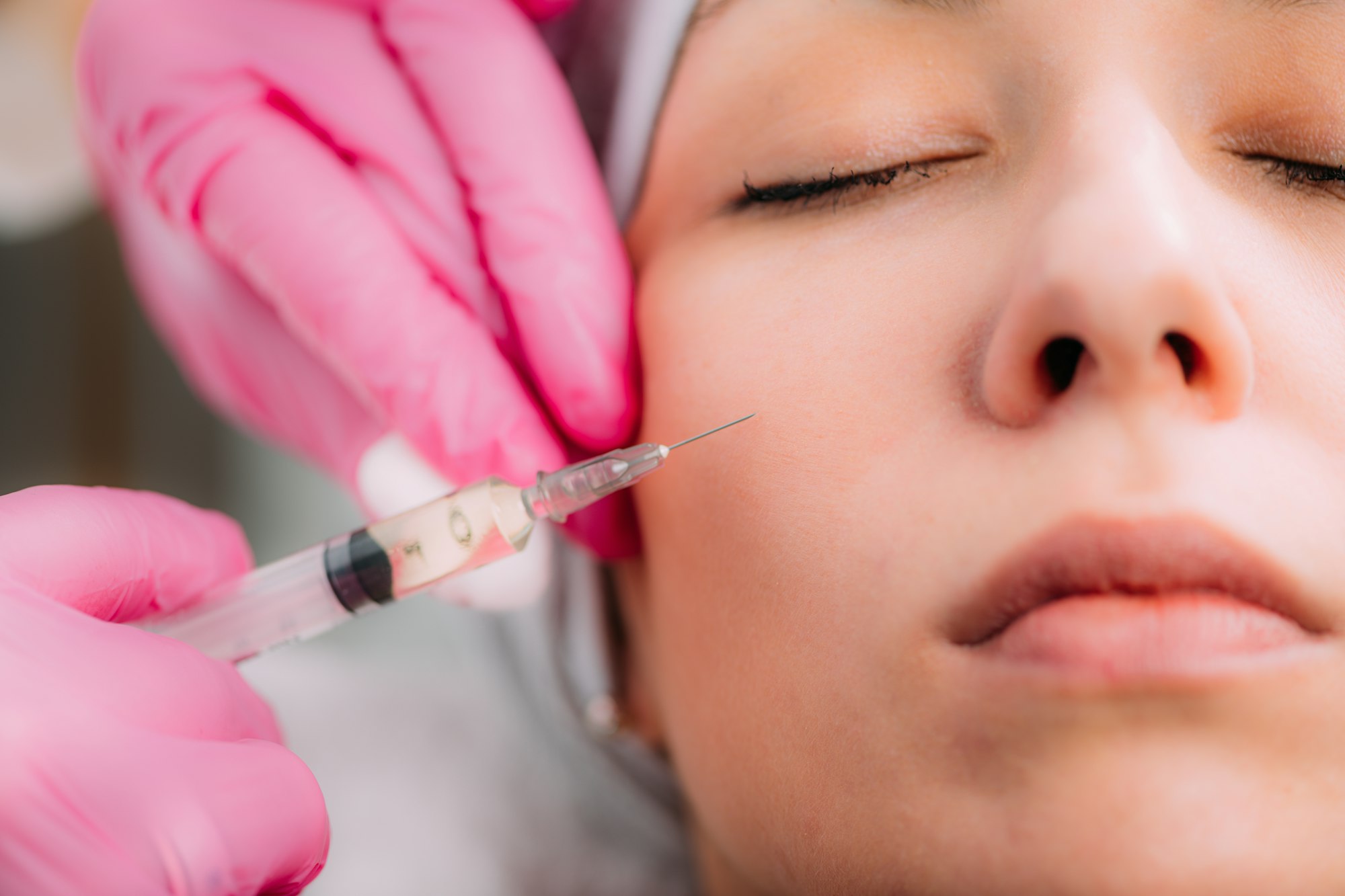 Dermal Filler Injection for Cheeks